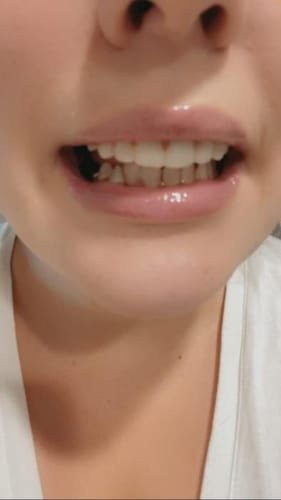 Snap On False Teeth Upper + Lower Dental Instant Veneers Dentures Tooth Cover White | Natural Look photo review