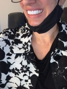 StoreTom Unisex Snap-On Veneers  | Natural Look | Instant Smile | BPA-Free| 1 pair (Uper and lower) photo review