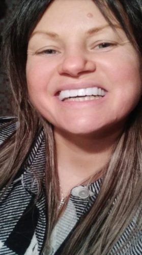 StoreTom Unisex Snap-On Veneers  | Natural Look | Instant Smile | BPA-Free| 1 pair (Uper and lower) photo review