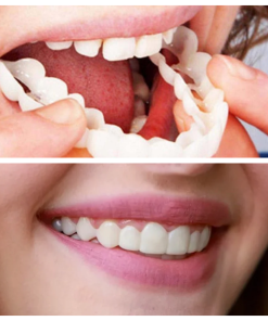 Snap On False Teeth Upper + Lower Dental Instant Veneers Dentures Tooth Cover White | Natural Look