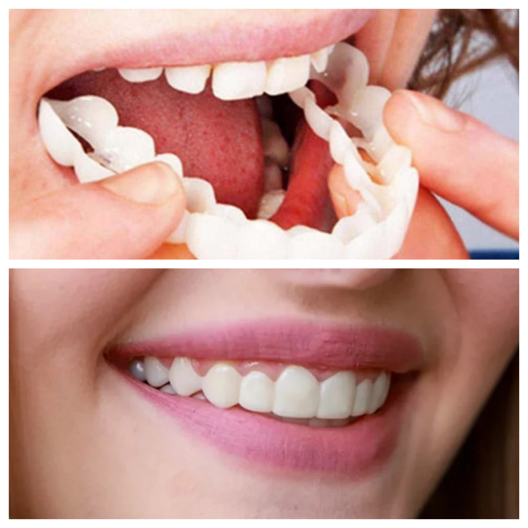 Snap On False Teeth Upper + Lower Dental Instant Veneers Dentures Tooth Cover White | Natural Look photo review